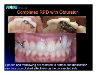 24.(new)mfp defects and rpd design | PDF