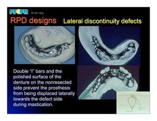 24.(new)mfp defects and rpd design | PDF