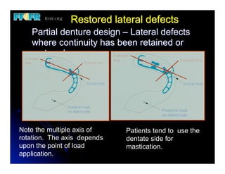 24.(new)mfp defects and rpd design | PDF