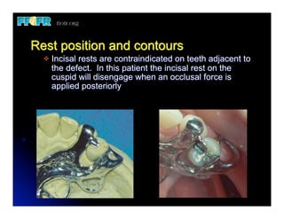 Mesial Rest Rpd 24.(new)mfp defects and rpd design | PDF