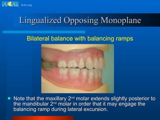 Maxillary Ramps 24.refine denture setup | PPT