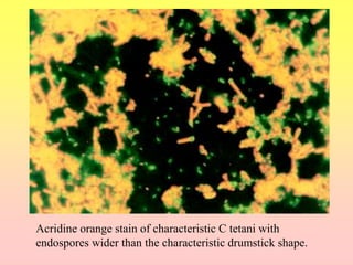 Acridine orange stain of characteristic C tetani with
endospores wider than the characteristic drumstick shape.
 