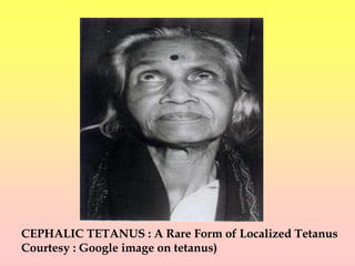 CEPHALIC TETANUS : A Rare Form of Localized Tetanus
Courtesy : Google image on tetanus)
 
