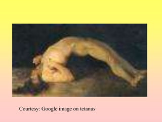 Courtesy: Google image on tetanus
 