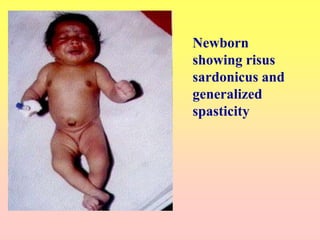 Newborn
showing risus
sardonicus and
generalized
spasticity
 