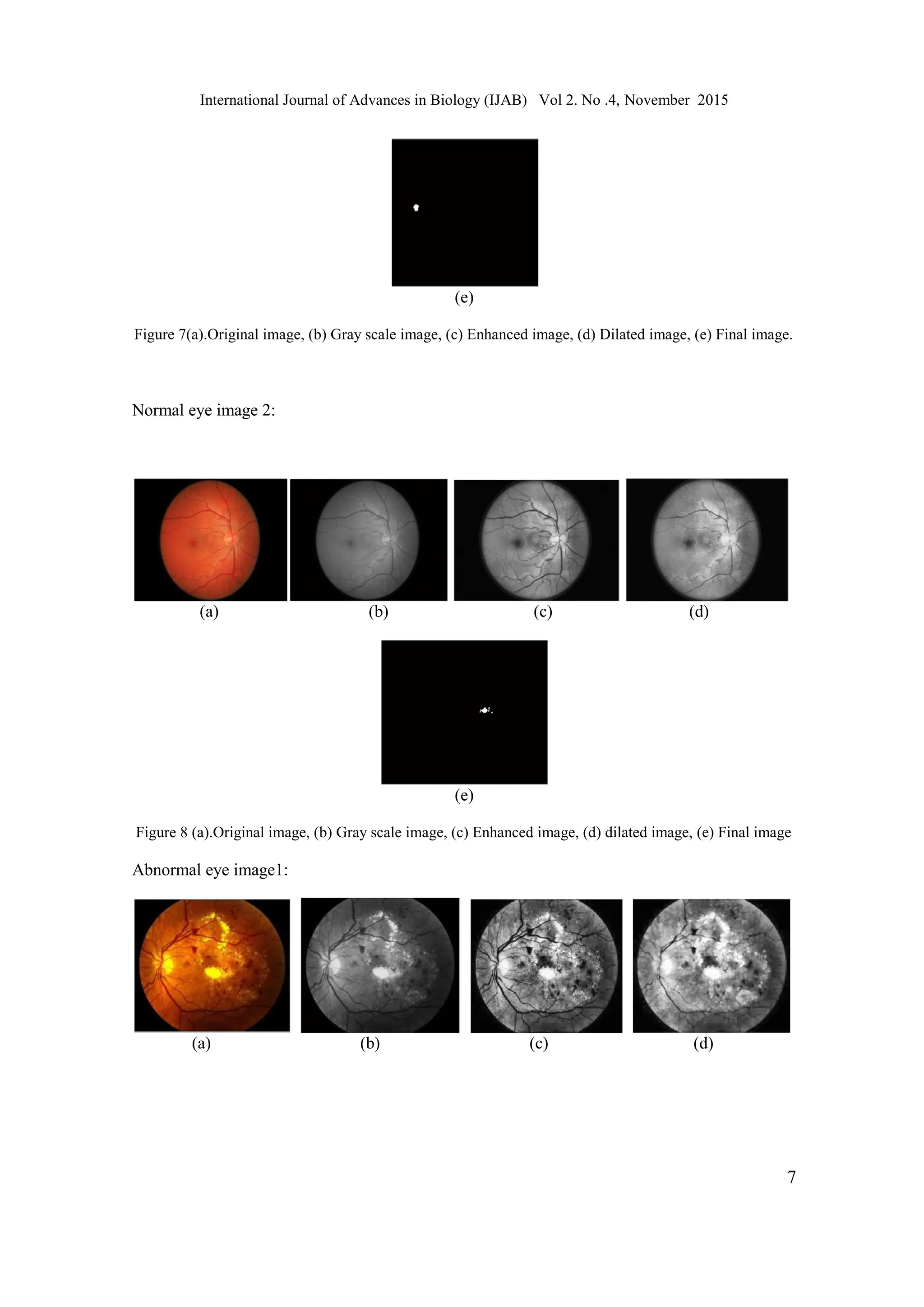 International Journal of Advances in Biology (IJAB) Vol 2. No .4, November 2015
7
(e)
Figure 7(a).Original image, (b) Gray scale image, (c) Enhanced image, (d) Dilated image, (e) Final image.
Normal eye image 2:
(a) (b) (c) (d)
(e)
Figure 8 (a).Original image, (b) Gray scale image, (c) Enhanced image, (d) dilated image, (e) Final image
Abnormal eye image1:
(a) (b) (c) (d)
 