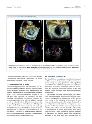 management Mitral valve Regurgitaion | PDF