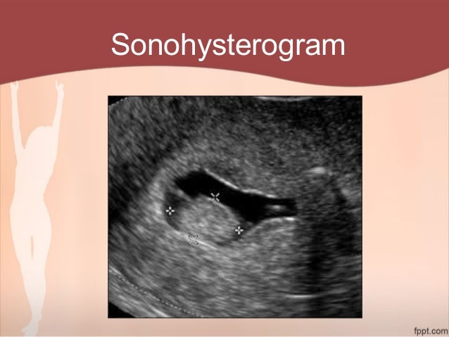 Abnormal Uterine Bleeding in Perimenopausal Women Abnormal Uterine Bleeding in Perimenopausal Women