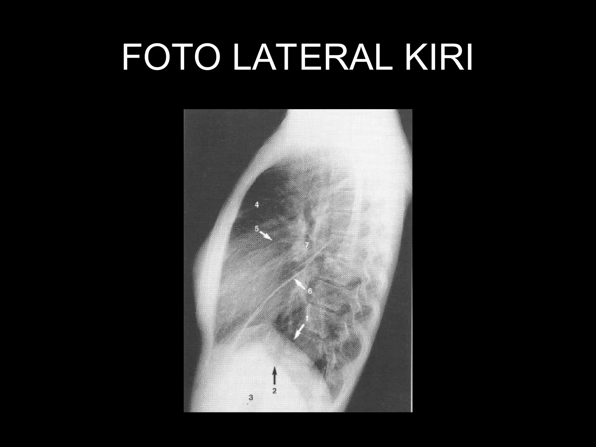 Hasil Rontgen Thorax 243221265-129577767-Cara-Mudah-Membaca-Rontgen-Thorax-ppt.ppt