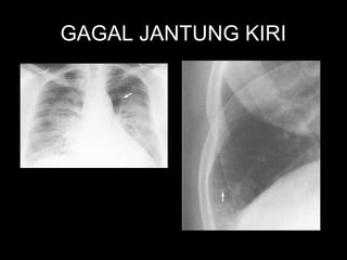 Hasil Rontgen Thorax 243221265-129577767-Cara-Mudah-Membaca-Rontgen-Thorax-ppt.ppt
