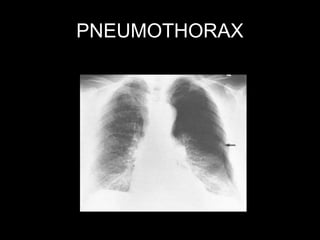 Hasil Rontgen Thorax 243221265-129577767-Cara-Mudah-Membaca-Rontgen-Thorax-ppt.ppt