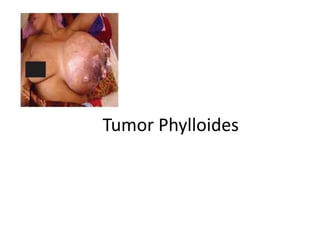 Tumor Phylloides
 