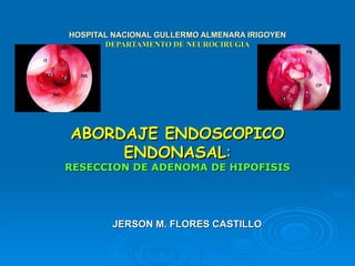 Cirugía endoscópica endonasal - CICAT-SALUD