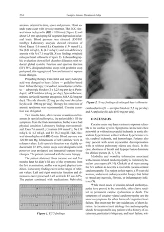 anxious, oriented to time, space and persons. Heart so-
unds were clear with systolic murmur. The ECG sho-
wed sinus tachycardia (HR > 100/min) (Figure 1) and
about 0,5 mm upsloping ST segment depression in lat-
eral leads. Blood pressure was elevated (150/105
mmHg). Laboratory analysis showed elevation of
blood Urea (10.6 mmol/L), Creatinine (154 mmol/L),
Na (149 mEq/L), K (4.2 mEq/L) and iron-deficiency
anemia with Fe (7.1 mcg/dl). X-ray findings obtained
enlarged heart silhouette (Figure 2). Echocardiograp-
hic evaluation showed left chamber dilatation with re-
duced global systolic function and ejection fraction
(EF) 38%, designated mitral cusps with posterior cusp
prolapsed, thin regurgitated flow and intraatrial septum
tissue changes.
Preceding therapy Carvedilol and Acetylsalicylic
acid was changed to heart failure — guideline-based
heart failure therapy: Carvedilol, nonselective alfa/be-
ta — adrenergic blocker (2 x 6,25 mg per day), Perin-
dopril, ACE inhibitor (4 mg per day), Spironolactone,
mineral corticoid receptor antagonist, MRA(25 mg per
day), Thiazide diuretic (25 mg per day) and Acetylsa-
licylic acid (100 mg per day). Therapy for correction of
anemic syndrome was recommended. Cocaine cessa-
tion was obligated.
Two months later, after cocaine cessation and tre-
atment in specialized hospital, the patient didn’t fill the
symptoms from the first examination, but he was at bad
physical condition. Laboratory findings were normali-
zed: Urea 7.6 mmol/L; Creatinin 108 mmol/L; Na 139
mEq/L; K 4.2 mEq/L and Fe 16.2 mcg/dl. EKG sho-
wed sinus rhythm with HR 65/min. Blood pressure was
120/80 mm Hg. Dimensions of left ventricle were in
referent values. Left ventricle function was slightly re-
duced with EF 49%, mitral cusps were designated with
posterior cusp prolapsed and intraatrial septum tissue
changes. The patient continued with the same therapy.
The patient abstained from cocaine use and five
months later he didn’t fill any of the symptoms from
the first examination, and he was in good physical con-
dition. Laboratory findings were in the ranges of refer-
ent values. Left and right ventricles function and di-
mensions were preserved. Left ventricle EF was 62%.
The patient continued with medications: Nebivolol,
cardioselectiveb1 — receptor blocker (2,5 mg per day)
and Acetylsalicylic acid (100 mg per day).
DISCUSSION
Cocaine users may have various symptoms refera-
ble to the cardiac system. Symptoms can include chest
pain with or without myocardial ischemia or aortic dis-
section, hypertension with or without hypertensive cri-
sis, cerebral ischemia, and hemorrhage. Patients also
may present with acute myocardial decompensation
with or without pulmonary edema and shock. In this
case, shortness of breath and hypoperfusion dominate
the clinical picture (1, 6, 7, 8).
Morbidity and mortality information associated
with cocaine-related cardiomyopathy is commonly ba-
sed on case reports (9, 10). Chokshi et al. were among
the first authors to describe a reversible cocaine-related
cardiomyopathy. The patient in their report, a 35-year-old
woman, underwent endomyocardial biopsy that failed
to reveal any necrosis, fibrosis, or inflammatory infil-
trate (9).
While most cases of cocaine-related cardiomyo-
pathy have proved to be reversible, others have resul-
ted in permanent cardiac dysfunction or death. The
symptoms of cocaine-related cardiomyopathy are the
same as symptoms for other forms of congestive heart
failure. The onset may be very sudden and of short du-
ration. A cocaine-related etiology for cardiomyopathy
should be suspected in any patient with a history of co-
caine use, particularly binge use, and heart failure, wit-
234 Georgiev Antonio, Zhivadinovik Julija
Figure 1. ECG findings
Figure 2. X-ray findings of enlarged heart silhouette
 