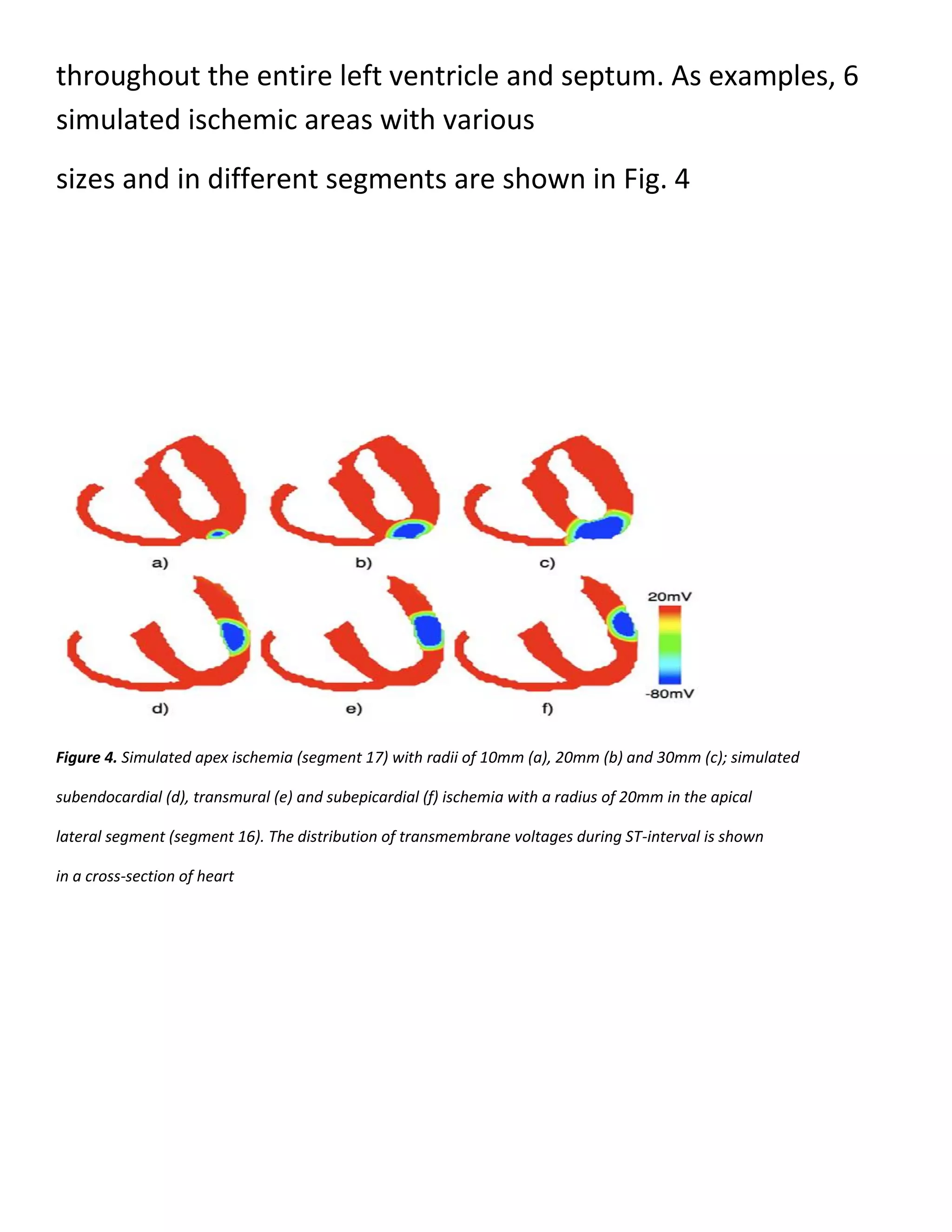 throughout the entire left ventricle and septum. As examples, 6
simulated ischemic areas with various
sizes and in different segments are shown in Fig. 4
Figure 4. Simulated apex ischemia (segment 17) with radii of 10mm (a), 20mm (b) and 30mm (c); simulated
subendocardial (d), transmural (e) and subepicardial (f) ischemia with a radius of 20mm in the apical
lateral segment (segment 16). The distribution of transmembrane voltages during ST-interval is shown
in a cross-section of heart
 