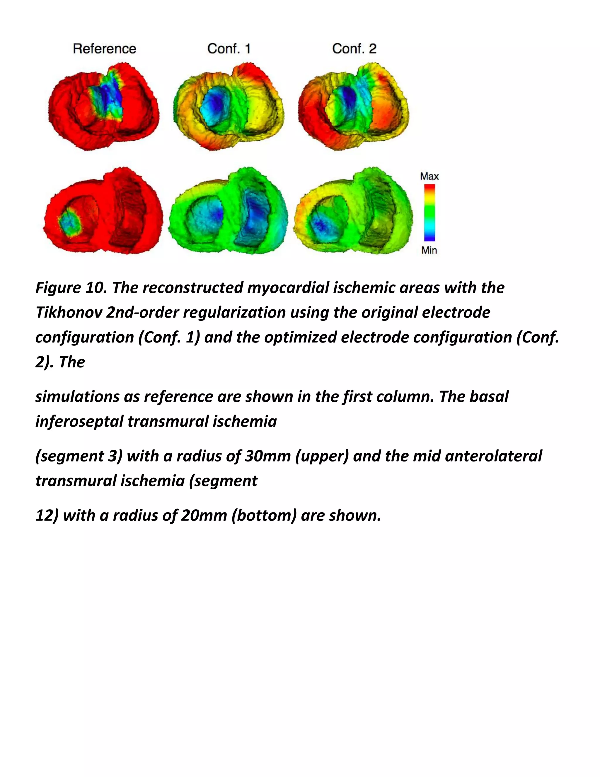 Figure 10. The reconstructed myocardial ischemic areas with the
Tikhonov 2nd-order regularization using the original electrode
configuration (Conf. 1) and the optimized electrode configuration (Conf.
2). The
simulations as reference are shown in the first column. The basal
inferoseptal transmural ischemia
(segment 3) with a radius of 30mm (upper) and the mid anterolateral
transmural ischemia (segment
12) with a radius of 20mm (bottom) are shown.
 