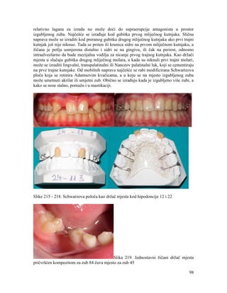 98
relativno lagana za izradu no može doći do supraerupcije antagonista u prostor
izgubljenog zuba. Najčešće se izrađuje kod gubitka prvog mliječnog kutnjaka. Slična
naprava može se izraditi kod preranog gubitka drugog mliječnog kutnjaka ako prvi trajni
kutnjak još nije niknuo. Tada se prsten ili krunica sidre na prvom mliječnom kutnjaku, a
žičana je petlja usmjerena distalno i sidri se na gingivu, ili čak na periost, odnosno
intraalveolarno da bude mezijalna vodilja za nicanje prvog trajnog kutnjaka. Kao držači
mjesta u slučaju gubitka drugog mliječnog molara, a kada su niknuli prvi trajni molari,
može se izraditi lingvalni, transpalatinalni ili Nanceov palatinalni luk, koji se cementiraju
na prve trajne kutnjake. Od mobilnih naprava najčešće se rabi modificirana Schwartzova
ploča koja se retinira Adamsovim kvačicama, a u koju se na mjesto izgubljenog zuba
može umetnuti akrilat ili umjetni zub. Obično se izrađuju kada je izgubljeno više zubi, a
kako se nose stalno, pomažu i u mastikaciji.
Slike 215 - 218. Schwarzova poloča kao držač mjesta kod hipodoncije 12 i 22
Slika 219. Jednostavni žičani držač mjesta
pričvršćen kompozitom za zub 84 čuva mjesto za zub 45
 