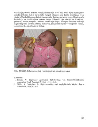 102
Ukoliko je potrebna dodatna pomoć pri hranjenju, osoba koja hrani dijete može nježno
ritmički pritiskati dudu te na taj način pumpati mlijeko u usta djeteta. Izumiteljica ovog
sisača je Mandy Haberman, koja je i sama majka djeteta s rascjepom nepca. Dizajn sisača
bazirala je na istraživanjima procesa sisanja dojenčadi koja ukazuju da je dojenje,
primarno, proces pumpanja, odnosno istiskivanja mlijeka iz dojke temeljem stvaranja
negativnog tlaka u ustima i kretnji mandibule, dok je hranjenje na bočicu proces sisanja,
odnosno navlačenja tekućine iz bočice.
Slike 225 i 226. Habermanov sisač i hranjenje djeteta s rascjepom nepca
Literatura:
1. Balters W. Ergebnisse gesteuerter Selbstheilung von kieferorthopädischen
Anomalien. Dtsch Zahnärztl Z. 1960; 15: 241–248.
2. Müller A. Prophylaxe der Kieferanomalien und prophylaktische Geräte. Dtsch
Zahnärztl Z. 1956; 10: 1–7.
 