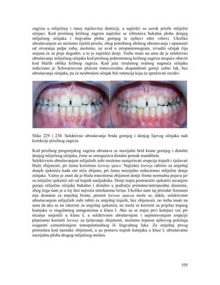 105
zagrizu u mliječnoj i ranoj mješovitoj denticiji, a najčešći su uzrok prisile mliječni
očnjaci. Kod prislinog križnog zagriza najčešće se izbrušava bukalna ploha donjeg
mliječnog očnjaka i lingvalna ploha gornjeg te njihovi oštri vrhovi. Ukoliko
ubrušavanjem ne možemo riješiti prisilu, zbog potrebnog obilnog ubrušavanja i opasnosti
od otvaranja pulpe zuba, možemo, uz uvid u ortopantomogram, izvaditi očnjak čija
smjena će se prije dogoditi, a to je najčešće donji. Treba imati na umu da je selektivno
ubrušavanje mliječnog očnjaka kod prislnog jednostranog križnog zagriza moguće obaviti
kod blažih oblika križnog zagriza. Kod ječe izraženog oralnog nagnuća očnjaka
indicirano je Schwarzovom pločom transverzalno ekspandirati gornji zubni luk, bez
ubrušavanja očnjaka, pa će neubrušeni očnjak biti retencija koja će sprečavati recidiv.
Slike 229 i 230. Selektivno ubrušavanje brida gornjeg i donjeg lijevog očnjaka radi
korekcije prisilnog zagriza
Kod prisilnog progenijskog zagriza ubrušava se mezijalni brid krune gornjeg i distalni
donjeg mliječnog očnjaka, čime se omogućava distalni pomak mandibule.
Selektivnim ubrušavanjem mliječnih zubi možemo usmjeravati erupciju trajnih i rješavati
blaže zbijenosti, pri čemu koristimo leeway space. Najčešće leeway rabimo za smještaj
donjih sjekutića kada oni niču zbijeno, pri čemu mezijalno reduciramo mliječne donje
očnjake. Važno je znati da je blaža tranzitorna zbijenost donje fronte normalna pojava jer
su mliječni sjekutići uži od trajnih nasljednika. Donji trajni postranični sjekutići nicanjem
guraju mliječne očnjake bukalno i distalno u područje primatne/antropoidne diasteme,
zbog čega nam je u toj fazi najveća interkanina širina. Ukoliko nam taj prirodni fenomen
nije dostatan za smještaj fronte, prostor leeway spacea može se, dakle, selektivnim
ubrušavanjem mliječnih zubi rabiti za smještaj trajnih, bez zbijenosti, no treba imati na
umu da ako se on iskoristi za smještaj sjekutića, ne može se koristiti za prijelaz trajnog
kutnjaka iz singularnog antagonizma u klasu I. Ako su se trajni prvi kutnjaci već pri
nicanju smjestili u klasu I, a selektivnim ubrušavnjem i usjmeravanjem erupcije
planiramo koristiti leeway za rješavanje zbijenosti, možemo trajnost njihovog položaja
osigurati cementiranjem transpalatinalnog ili lingvalnog luka. Za smještaj prvog
premolara kod naznake zbijenosti, a uz postavu trajnih kutnjaka u klasi I, ubrušavamo
mezijalnu plohu drugog mliječnog molara.
 