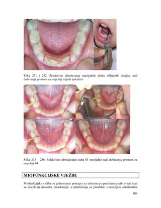 106
Slike 231 i 232. Selektivno ubrušavanje mezijalnih ploha mliječnih očnjaka radi
dobivanja prostora za smještaj trajnih sjekutića
Slike 233 – 236. Selektivno ubrušavanje zuba 85 mezijalno radi dobivanja prostora za
smještaj 44
MIOFUNKCIJSKE VJEŽBE
Miofunkcijske vježbe su jednostavni postupci za eliminaciju parafunkcijskih uvjeta koji
su doveli da nastanka malokluzije, a prakticiraju se paralelno s nošenjem ortodontske
 