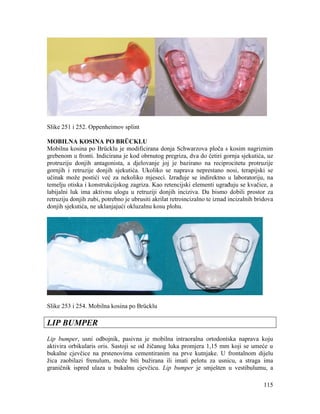 115
Slike 251 i 252. Oppenheimov splint
MOBILNA KOSINA PO BRÜCKLU
Mobilna kosina po Brücklu je modificirana donja Schwarzova ploča s kosim nagriznim
grebenom u fronti. Indicirana je kod obrnutog pregriza, dva do četiri gornja sjekutića, uz
protruziju donjih antagonista, a djelovanje joj je bazirano na reciprocitetu protruzije
gornjih i retruzije donjih sjekutića. Ukoliko se naprava neprestano nosi, terapijski se
učinak može postići već za nekoliko mjeseci. Izrađuje se indirektno u laboratoriju, na
temelju otiska i konstrukcijskog zagriza. Kao retencijski elementi ugrađuju se kvačice, a
labijalni luk ima aktivnu ulogu u retruziji donjih inciziva. Da bismo dobili prostor za
retruziju donjih zubi, potrebno je ubrusiti akrilat retroincizalno te iznad incizalnih bridova
donjih sjekutića, ne uklanjajući okluzalnu kosu plohu.
Slike 253 i 254. Mobilna kosina po Brücklu
LIP BUMPER
Lip bumper, usni odbojnik, pasivna je mobilna intraoralna ortodontska naprava koju
aktivira orbikularis oris. Sastoji se od žičanog luka promjera 1,15 mm koji se umeće u
bukalne cjevčice na prstenovima cementiranim na prve kutnjake. U frontalnom dijelu
žica zaobilazi frenulum, može biti bužirana ili imati pelotu za usnicu, a straga ima
graničnik ispred ulaza u bukalnu cjevčicu. Lip bumper je smješten u vestibulumu, a
 