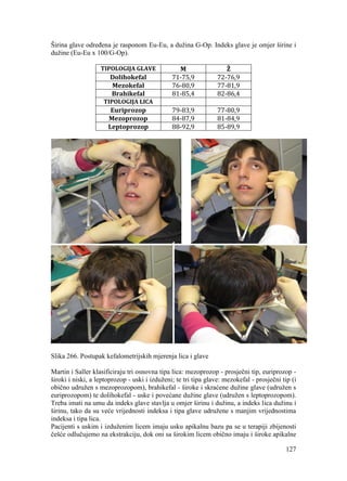 127
Širina glave određena je rasponom Eu-Eu, a dužina G-Op. Indeks glave je omjer širine i
dužine (Eu-Eu x 100/G-Op).
TIPOLOGIJA GLAVE M Ž
Dolihokefal 71-75,9 72-76,9
Mezokefal 76-80,9 77-81,9
Brahikefal 81-85,4 82-86,4
TIPOLOGIJA LICA
Euriprozop 79-83,9 77-80,9
Mezoprozop 84-87,9 81-84,9
Leptoprozop 88-92,9 85-89,9
Slika 266. Postupak kefalometrijskih mjerenja lica i glave
Martin i Saller klasificiraju tri osnovna tipa lica: mezoprozop - prosječni tip, euriprozop -
široki i niski, a leptoprozop - uski i izduženi; te tri tipa glave: mezokefal - prosječni tip (i
obično udružen s mezoprozopom), brahikefal - široke i skraćene dužine glave (udružen s
euriprozopom) te dolihokefal - uske i povećane dužine glave (udružen s leptoprozopom).
Treba imati na umu da indeks glave stavlja u omjer širinu i dužinu, a indeks lica dužinu i
širinu, tako da su veće vrijednosti indeksa i tipa glave udružene s manjim vrijednostima
indeksa i tipa lica.
Pacijenti s uskim i izduženim licem imaju usku apikalnu bazu pa se u terapiji zbijenosti
češće odlučujemo na ekstrakciju, dok oni sa širokim licem obično imaju i široke apikalne
 