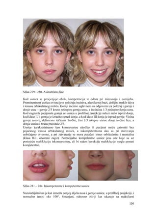 130
Slika 279 i 280. Asimetrično lice
Kod usnica se procjenjuje oblik, kompetencija te odnos pri mirovanju i osmijehu.
Prominentnost usnica ovisna je o položaju inciziva, alveolarnoj bazi, debljini mekih tkiva
i tonusu orbikularnog mišića. Gornji incizivi uglavnom su odgovorni za položaj i gornje i
donje usne – gornje 2/3 krune podupiru gornju usnu, a incizalna 1/3 podupire donju usnu.
Kod eugnatih pacijenata gornja se usnica u profilnoj projekciji nalazi malo ispred donje,
kod klase II/1 gornja je izrazito ispred donje, a kod klase III donja je ispred gornje. Visina
gornje usnice, definirana točkama Sn-Sto, čini 1/3 ukupne visine donje trećine lica, a
donja usnica i brada preostale 2/3.
Usnice karakteriziramo kao kompetentne ukoliko ih pacijent može zatvoriti bez
pojačanog tonusa orbikularnog mišića, a inkompetentnima ako su pri mirovanju
uobičajeno otvorene, a pri zatvaranju se mora pojačati tonus orbikularisa i mentalisa
(klasa II/1, otvoreni zagiz). Potencijalno kompetentne usnice jesu one koje su uz
postojeću malokluziju inkompetentne, ali bi nakon korekcije malokluzije mogle postati
kompetentne.
Slika 281 – 284. Inkompetentne i kompetentne usnice
Nazolabijalni kut je kut između donjeg dijela nosa i gornje usnice, u profilnoj projekciji, i
normalno iznosi oko 100°. Smanjeni, odnosno oštriji kut ukazuje na maksilarni
 