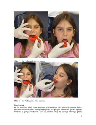 8
Slike 13 i 14. Proba donje žlice u ustima
Slike 15 i 16. Proba gornje žlice u ustima
Gornji otisak
Za što precizniji gornji otisak možemo, prije unošenja žlice prstom iz gumene šalice,
aplicirati dodatno alginata na nepce (pogotovo ako pacijent ima visoko gotsko nepce) i
frontalno u gornji vestibulum. Žlica se centrira straga te utiskuje odostraga prema
 