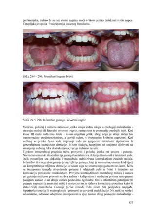 137
pretkutnjaka, trebao bi na toj visini zagriza moći vrškom jezika dotaknuti tvrdo nepce.
Terapijska je opcija freulektomija jezičnog frenuluma.
Slike 294 – 296. Frenulum linguae breve
Slike 297 i 298. Infantilno gutanje i otvoreni zagriz
Veličina, položaj i mišićna aktivnost jezika imaju važnu ulogu u etiologiji malokluzija -
stvaraju prednji ili lateralni otvoreni zagriz, rastresitost te protruziju prednjih zubi. Kod
klase III često nalazimo širok i nisko smješten jezik, zbog čega je donji zubni luk
transverzalno predimenzioniran, a gornji sužen, s obostranim križnim zagrizom. Kod
velikog se jezika često vide impresije zubi na njegovim lateralnim dijelovima te
generalizirana rastresitost denticije. U tom slučaju, terapijom ne smijemo djelovati na
smanjenje zubnog luka ekstrakcijama, već ga trebamo razviti.
Tijekom intraoralnog pregleda treba provjeriti i položaj jezika pri govoru i gutanju.
Normalni somatski ili adultni tip gutanja karakterizira okluzija frontalnih i lateralnih zubi,
jezik postavljen iza sjekutića i mandibula stabilizirana kontrakcijom žvačnih mišića.
Infantilno ili visceralno gutanje je nezreli tip gutanja, koji je normalno prisutan kod djece
do kompletiranja mliječne denticije, a nakon toga se smatra nepogodnom navikom. Jezik
se interponira između alveolarnih grebena i mliječnih zubi u fronti i lateralno uz
kontrakciju perioralne muskulature. Provjeru kontraktilnosti mentalnog mišića i usnica
pri gutanju možemo prevesti na dva načina - kažiprstima i srednjim prstima rastegnemo
pacijentu usnice ili na donju usnicu postavimo ogledalce. Oni s infantilnim gutanjem pri
gutanju napinjat će mentalni mišić i usnice jer im je njihova kontrakcija potrebna kako bi
stabilizirali mandibulu. Guranje jezika između zubi može biti posljedica nasljeđa,
hipertrofije tonzila ili makroglosije i primarni je uzročnik malokluzije. No jezik se može i
sekundarno, odnosno adaptivno interponirati u zjap nastao zbog postojeće malokluzije -
 