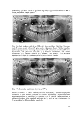 143
postraničnog sjekutića, očnjak će apsorbirati rtg zrake i njegova će se kruna na OPT-u
vidjeti jasnije nego korijen sjekutića.
Slika 306. Opis struktura vidljivih na OPT-u: (1) sinus maxillaris, (2) orbita, (3) spetum
nasi, (4) concha nasalis inferior, (5) spina nasalis, (6) palatum durum, (7) tuber maxillae,
(8) fossa pterygopalatina i fissura pterygomaxillaris, (9) tuberculum articulare, (10) arcus
zygomaticus, (11) processus condylaris, (12) processus coronoideus, (13) canalis
mandibulae, (14) foramen mentale, (15) vertebra, (16) pharynx, (17) processus
styloideus, (18) lingua, (19) os hyoideum, (20) porus acusticus externus.
Slika 307. Dva načina analiziranja simetrije na OPT-u
Za analizu simetrije na OPT-u označimo tri točke: menton (M) – u sredini donjeg ruba
mandibule, uz spinu mentalis, gonion (Go) – najniža, najlateralnija i najdistalnija točka
angulusa mandibule, te condilion (Co) – najviša točka na kondilu. Visina mandibule je
udaljenost Co-Go, a širina mandibule udaljenost M-Go. Može se mjeriti i dijagonala Co-
M koja predstavlja efektivnu dužinu mandibule.
 