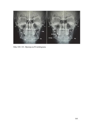 164
Slike 320 i 321. Mjerenja na PA kefalogramu
 