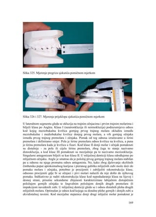 169
Slika 325. Mjerenje pregriza sjekutića pomičnom mjerkom
Slika 326 i 327. Mjerenje prijeklopa sjekutića pomičnom mjerkom
U lateralnom segmentu gleda se okluzija na trajnim očnjacima i prvim trajnim molarima i
bilježi klasa po Angleu. Klasa I (neutrookluzija ili normokluzija) podrazumijeva odnos
kod kojeg meziobukalna kvržica gornjeg prvog trajnog molara okludira između
meziobukalne i mediobukalne kvržice donjeg prvog molara, a vrh gornjeg očnjaka
između prvog trajnog premolara i očnjaka. Pomak od tog odnosa izražavamo u širini
premolara i definiramo smjer. Pola je širine premolara odnos kvržice na kvržicu, a puna
je širina premolara kada je kvržica u fisuri. Kod klase II donji molar i očnjak pomaknuti
su distalnije - za pola ili cijelu širinu premolara, zbog čega to stanje nazivamo
distookluzija, a kod klase III pomaknuti su mezijalnije pa to nazivamo meziookluzija.
Singularni antagonizam bilježi se kao klasa II. U mliječnoj denticiji klasu određujemo po
mliječnom očnjaku. Angle je smatrao da je položaj prvog gornjeg trajnog molara stabilan
pa u odnosu na njega promatra odnos antagonista. No, kako zbog djelovanja okolišnih
čimbenika poput aproksimalnog karijesa i preranog gubitka mliječnih zubi može doći do
pomaka molara i očnjaka, potrebno je procijeniti i zabilježiti rekonstrukciju klase,
odnosno procijeniti gdje bi se očnjaci i prvi molari nalazili da nije došlo do njihovog
pomaka. Indikativno je raditi rekonstrukciju klase kod nepodudaranja klasa na lijevoj i
desnoj strani, prisutne sekundarne zbijenosti karakterizirane labijalnim distopičnim
položajem gornjih očnjaka te lingvalnim položajem donjih drugih premolara ili
impakcijom navedenih zubi. U mliječnoj denticiji gleda se i odnos distalnih ploha drugih
mliječnih molara. Optimalan je odnos kod kojega su distalne plohe gornjih i donjih zubi u
ekvidistalnoj ravnini. Kod mezijalne stepenice donji drugi mliječni molar pomaknut je
 
