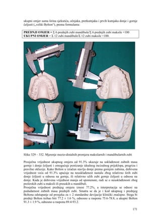 171
ukupni omjer suma širina sjekutića, očnjaka, pretkutnjaka i prvih kutnjaka donje i gornje
čeljusti („veliki Bolton“), prema formulama:
PREDNJI OMJER = Σ 6 prednjih zubi mandibule/Σ 6 prednjih zubi maksile ×100
UKUPNI OMJER = Σ 12 zubi mandibule/Σ 12 zubi maksile ×100.
Slike 329 – 332. Mjerenje mezio-distalnih promjera maksilarnih i mandibularnih zubi
Prosječna vrijednost ukupnog omjera od 91.3% ukazuje na usklađenost zubnih masa
gornje i donje čeljusti i omogućuje postizanje idealnog incizalnog prijeklopa, pregriza i
pravilne okluzije. Kako Bolton u izračun stavlja donje prema gornjim zubima, dobivena
vrijednost veća od 91.3% upućuje na neusklađenost nastalu zbog relativno širih zubi
donje čeljusti u odnosu na gornje, ili relativno užih zubi gornje čeljusti u odnosu na
donje. Kada je dobivena vrijednost manja od spomenute, radi se o neusklađenosti zbog
preširokih zubi u maksili ili preuskih u mandibuli.
Prosječna vrijednost prednjeg omjera iznosi 77.2%, a interpretacija se odnosi na
podudarnost zubnih masa prednjih zubi. Smatra se da je i kod ukupnog i prednjeg
Boltona odstupanje od prosjeka za ± 2 standardne devijacije klinički značajno. Stoga bi
prednji Bolton trebao biti 77.2 ± 1.6 %, odnosno u rasponu 75.6-78.8, a ukupni Bolton
91.3 ± 1.9 %, odnosno u rasponu 89.4-93.2.
 