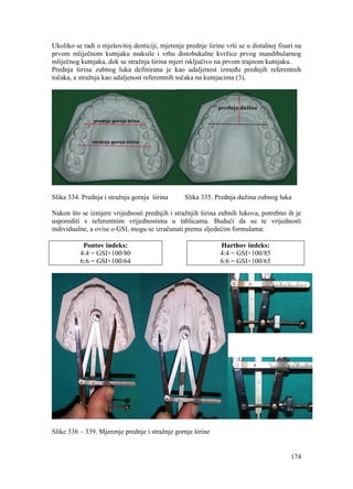 174
Ukoliko se radi o mješovitoj denticiji, mjerenje prednje širine vrši se u distalnoj fisuri na
prvom mliječnom kutnjaku maksile i vrhu distobukalne kvržice prvog mandibularnog
mliječnog kutnjaka, dok se stražnja širina mjeri isključivo na prvom trajnom kutnjaku.
Prednja širina zubnog luka definirana je kao udaljenost između prednjih referentnih
točaka, a stražnja kao udaljenost referentnih točaka na kutnjacima (3).
Slika 334. Prednja i stražnja gornja širina Slika 335. Prednja dužina zubnog luka
Nakon što se izmjere vrijednosti prednjih i stražnjih širina zubnih lukova, potrebno ih je
usporediti s referentnim vrijednostima u tablicama. Budući da su te vrijednosti
individualne, a ovise o GSI, mogu se izračunati prema sljedećim formulama:
Pontov indeks:
4:4 = GSI×100/80
6:6 = GSI×100/64
Harthov indeks:
4:4 = GSI×100/85
6:6 = GSI×100/65
Slike 336 – 339. Mjerenje prednje i stražnje gornje širine
 