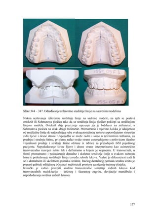177
Slike 344 – 347. Određivanje referentne središnje linije na sadrenim modelima
Nakon ucrtavanja referentne središnje linije na sadrene modele, na njih se postavi
ortokriž ili Schmutova pločica tako da se središnja linija pločice poklopi sa središnjom
linijom modela. Ortokriž daje preciznije mjerenje jer je baždaren na milimetar, a
Schmutova pločica na svaki drugi milimetar. Promatramo i mjerimo kolika je udaljenost
od medijalne linije do najoralnijeg ruba svakog pojedinog zuba te uspoređujemo simetriju
zubi lijeve i desne strane. Usporedba se može raditi i samo u referentnim točkama, za
prednju i stražnju širinu, pri čemu nalaz svake strane uspoređujemo s polovicom idealne
vrijednosti prednje i stražnje širine očitane iz tablice za pripadajući GSI pojedinog
pacijenta. Nepodudaranje širine lijeve i desne strane interpretiramo kao asimetrično
transverzalno razvijen zubni luk i definiramo u kojem je segmentu. U transverzali, u
fronti promatramo i podudaranje dentalne i skeletne središnje linije u svakom zubnom
luku te podudaranje središnjih linija između zubnih lukova. Važno je diferencirati radi li
se o dentalnom ili skeletnom pomaku sredine. Razlog dentalnog pomaka sredine često je
prerani gubitak mliječnog očnjaka i nedostatak prostora za nicanje trajnog očnjaka.
Klinički je važno provesti analizu transverzalne simetrije zubnih lukova kod
transverzalnih malokluzija – križnog i škarastog zagriza, devijacije mandibule i
nepodudaranja sredina zubnih lukova.
 