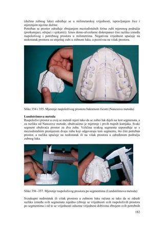 182
(dužina zubnog luka) određuje se u milimetarskoj vrijednosti, ispravljanjem žice i
mjerenjem njezine dužine.
Potreban se prostor određuje zbrajanjem meziodistalnih širina zubi mjerenog područja
(pretkutnjaci, očnjaci i sjekutići). Iznos dento-alveolarne diskrepance čini razlika između
raspoloživog i potrebnog prostora u milimetrima. Negativna vrijednost upućuje na
nedostatak prostora za smještaj zubi u zubnom luku, a pozitivna na višak prostora.
Slike 354 i 355. Mjerenje raspoloživog prostora bakrenom žicom (Nanceova metoda)
Lundströmova metoda
Raspoloživi prostor u ovoj se metodi mjeri tako da se zubni luk dijeli na šest segmenata, a
za razliku od Nanceove metode, obuhvaćeno je mjerenje i prvih trajnih kutnjaka. Svaki
segment obuhvaća prostor za dva zuba. Veličina svakog segmenta uspoređuje se s
meziodistalnim promjerom dvaju zuba koji odgovaraju tom segmentu, što čini potreban
prostor, a razlika upućuje na nedostatak ili na višak prostora u određenom području
zubnog luka.
Slike 356 -357. Mjerenje raspoloživog prostora po segmentima (Lundströmova metoda)
Sveukupni nedostatak ili višak prostora u zubnom luku računa se tako da se odredi
razlika između svih segmenata zajedno (zbroje se vrijednosti svih raspoloživih prostora
po segmentima i od te se vrijednosti oduzme vrijednost dobivena zbrojem svih potrebnih
 