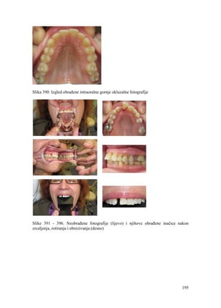 195
Slika 390. Izgled obrađene intraoralne gornje okluzalne fotografije
Slike 391 - 396. Neobrađene fotografije (lijevo) i njihove obrađene inačice nakon
zrcaljenja, rotiranja i obrezivanja (desno)
 