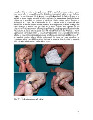 18
paralelne. Uške se zatim savinu pod kutem od 45° u vestibulo-oralnom smjeru i prema
kruni zuba, kako bi omogućile pravilno dosjedanje i retenciju kvačice za zub. Slobodni
krakovi žice savijaju se da slijede konture okluzalnih kontaktnih ploha između zubi, a na
oralnoj se strani moraju spuštati do gingivalnih papila, nakon čega formiraju lagano
koljeno da se odmaknu od sluznice te paralelno slijede konture oralne sluznice na
udaljenosti od 1 mm. To će omogućiti da žica s oralne strane u potpunosti bude
obuhvaćena akrilatnim tijelom mobilne naprave. S oralne je strane potrebno na kraju žice
saviti retenciju za akrilat. Vrlo je važno da je svako savijanje žice ispravno jer sve
korekcije savijanja povećavaju unutarnju napetost žice, zbog čega je sklonija lomovima.
Neizostavno je svaku fazu savijanja provjeriti na sadrenom modelu. Kvačica se nakon
toga voskom pričvrsti za model. U konačnici kvačica mora pasivno dosjedati na modelu,
uškama se pravilno retinirati za podminirane aproksimalne strane zuba pod kutem od 45°
na uzdužnu osovinu zuba, a njezin horizontalni dio mora biti malo odmaknut od
vestibularne plohe zuba i biti dovoljno nisko da ne smeta u okluziji. Kako bi osigurao
bolju retenciju, tehničar može malo radirati model.
Slike 55 – 58. Izrada Adamsove kvačice
 