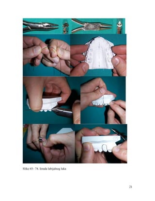 21
Slike 65– 74. Izrada labijalnog luka
 