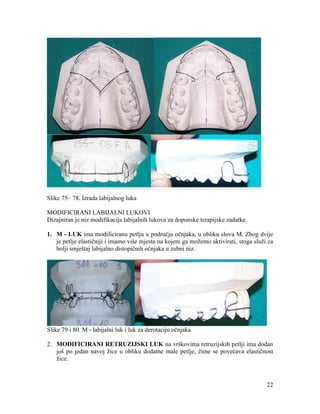 22
Slike 75– 78. Izrada labijalnog luka
MODIFICIRANI LABIJALNI LUKOVI
Dizajniran je niz modifikacija labijalnih lukova za dopunske terapijske zadatke.
1. M - LUK ima modificiranu petlju u području očnjaka, u obliku slova M. Zbog dvije
je petlje elastičniji i imamo više mjesta na kojem ga možemo aktivirati, stoga služi za
bolji smještaj labijalno distopičnih očnjaka u zubni niz.
Slike 79 i 80. M - labijalni luk i luk za derotaciju očnjaka
2. MODIFICIRANI RETRUZIJSKI LUK na vrškovima retruzijskih petlji ima dodan
još po jedan navoj žice u obliku dodatne male petlje, čime se povećava elastičnost
žice.
 