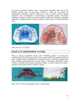 41
istovremeno protrudira frontalne zube i transverzalno ekspandira zubni luk te nije
potreban zaseban vijak za transverzalu. Ukoliko rez ploče ide iza očnjaka, ne
ekspandiramo interkanini segment. Umjesto dva vijka u Y-ploču možemo ugraditi
trosmjerni vijak za ekspanziju u transverzalnom i sagitalnom smjeru. Prvenstvena
indikacija za primjenu Y-ploče jest suženi maksilarni zubni luk s distopično smještenim
očnjacima i manjkom prostora za njihov smještaj u zubnom luku, uz retruziju frontalnih
zubi.
Slike 130 i 131. T i Y-ploča
PLOČA ZA NEPOGODNE NAVIKE
Ploča za terapiju nepogodnih navika, poput infantilnog gutanja ili sisanja prsta,
modifikacija je Schwarzove gornje ploče koja u nepčani akrilat ima ugrađenu rešetku za
jezik, a labijalni luk je girlandiformni te stimulira retruziju i ekstruziju frontalnih zubi
radi zatvaranja dentoalveolarnog otvorenog zagriza i retrudiranja protrudirane fronte.
Ukoliko je potrebna transverzalna ekspanzija, nepčani se akrilat separira po sredini i
ugrađuje vijak za transverzalu ili Coffinova opruga.
Slike 132 i 133. Ploča za nepogodne navike i nagrizna ploča
 