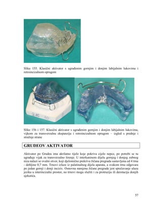 57
Slika 155. Klasični aktivator s ugrađenim gornjim i donjim labijalnim lukovima i
retroincizalnom oprugom
Slike 156 i 157. Klasični aktivator s ugrađenim gornjim i donjim labijalnim lukovima,
vijkom za transverzalnu ekspanziju i retroincizalnom oprugom – izgled s prednje i
stražnje strane
GRUDEOV AKTIVATOR
Aktivator po Grudeu ima akrilatno tijelo koje pokriva cijelo nepce, po potrebi se tu
ugrađuje vijak za transverzalno širenje. U interkaninom dijelu gornjeg i donjeg zubnog
niza nalazi se ovalni otvor, koji djelomično prekriva žičana pregrada sastavljena od 4 trna
- debljine 0,7 mm. Trnovi izlaze iz palatinalnog dijela aparata, a svakom trnu odgovara
po jedan gornji i donji inciziv. Osnovna namjena žičane pregrade jest sprečavanje ulaza
jezika u interincizalni prostor, no trnovi mogu služiti i za protruziju ili derotaciju donjih
sjekutića.
 