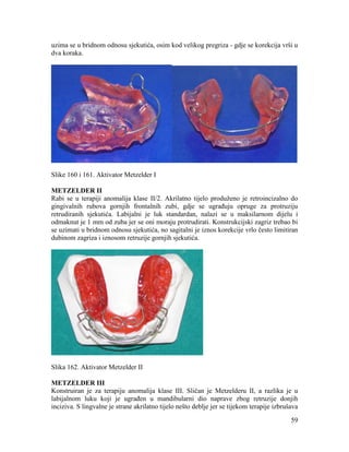 59
uzima se u bridnom odnosu sjekutića, osim kod velikog pregriza - gdje se korekcija vrši u
dva koraka.
Slike 160 i 161. Aktivator Metzelder I
METZELDER II
Rabi se u terapiji anomalija klase II/2. Akrilatno tijelo produženo je retroincizalno do
gingivalnih rubova gornjih frontalnih zubi, gdje se ugrađuju opruge za protruziju
retrudiranih sjekutića. Labijalni je luk standardan, nalazi se u maksilarnom dijelu i
odmaknut je 1 mm od zuba jer se oni moraju protrudirati. Konstrukcijski zagriz trebao bi
se uzimati u bridnom odnosu sjekutića, no sagitalni je iznos korekcije vrlo često limitiran
dubinom zagriza i iznosom retruzije gornjih sjekutića.
Slika 162. Aktivator Metzelder II
METZELDER III
Konstruiran je za terapiju anomalija klase III. Sličan je Metzelderu II, a razlika je u
labijalnom luku koji je ugrađen u mandibularni dio naprave zbog retruzije donjih
inciziva. S lingvalne je strane akrilatno tijelo nešto deblje jer se tijekom terapije izbrušava
 