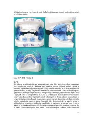 65
uključuju pijenje na cjevčicu te držanje čačkalice ili dugmeta između usnica, čime se jača
m. orbikularis oris.
Slike 169 - 172. Fränkel 2
TIP 3
Koristi se u terapiji maksilarnog retrognatizma u klasi III, a najbolje rezultate producira u
ranoj mješovitoj denticiji. Naprava ima ugrađene gornje labijalne pelote kojima se
stimulira sagitalni razvoj gornje čeljusti. Gornji retroincizalni luk aktivira se za protruziju
gornjih inciziva, a donji labijalni luk za retruziju donjih inciziva. Donji okluzijski upirači
sprečavaju izrastanje donjih molara, a omogućavaju izrastanje gornjih molara prema dolje
i naprijed, čime se korigira klasa III. Kako je kod klase III maksila često i transverzalno
nerazvijena, bukalni štitovi priliježu uz alveolarni greben donje čeljusti, a odmaknuti su
od gornje čeljusti stimulirajući njezin transverzalni razvoj. Kako nije potreban mezijalni
položaj mandibule, naprava nema lingvalni štit. Konstrukcijski se zagriz uzima u
najdistalnijem nenasilnom položaju mandibule, a vertiklano se otvara oko 2 mm u
području molara kako bismo dobili dovoljno prostora za korekciju obrnutog pregriza. Svi
se tipovi Fränkelove naprave nose stalno - osim tijekom jela, četkanja zubi i kontaktnih
 