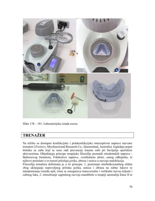 70
Slike 178 – 181. Laboratorijska izrada essixa
TRENAŽER
Na tržištu su dostupne konfekcijske i polukonfekcijske interceptivne naprave nazvane
trenažeri (Trainers, Myofunctional Research Co., Queensland, Australia). Izgledaju poput
štitnika za zube koji se nose radi prevencije trauma zubi pri bavljenju sportskim
aktivnostima. Objedinjuju principe terapijske filozofije poznatih ortodontskih naprava -
Baltersovog bionatora, Fränkelove naprave, vestibularne ploče, usnog odbojnika, te
njihove postulate o ovisnosti položaja jezika, obraza i usnica u razvoju malokluzija.
Filozofija trenažera definirana je u tri principa: 1. postizanje miofunkcionalnog efekta
zbog uklanjanja nepovoljnog pritiska jezika, usnica i obraza na zubne lukove te
interponiranja između njih, čime se omogućava transverzalni i vertikalni razvoj čeljusti i
zubnog luka, 2. stimuliranje sagitalnog razvoja mandibule u terapiji anomalija klase II te
 
