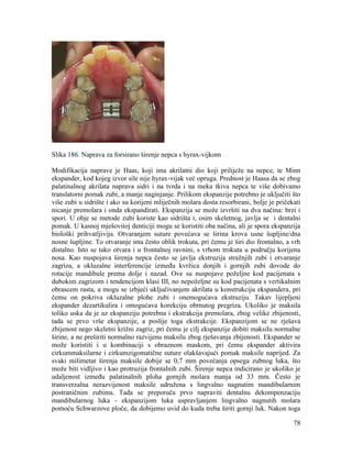 78
Slika 186. Naprava za forsirano širenje nepca s hyrax-vijkom
Modifikacija naprave je Haas, koji ima akrilatni dio koji priliježe na nepce, te Minn
ekspander, kod kojeg izvor sile nije hyrax-vijak već opruga. Prednost je Haasa da se zbog
palatinalnog akrilata naprava sidri i na tvrda i na meka tkiva nepca te više dobivamo
translatorni pomak zubi, a manje naginjanje. Prilikom ekspanzije potrebno je uključiti što
više zubi u sidrište i ako su korijeni mliječnih molara dosta resorbirani, bolje je pričekati
nicanje premolara i onda ekspandirati. Ekspanzija se može izvršiti na dva načina: brzi i
spori. U obje se metode zubi koriste kao sidrišta i, osim skeletnog, javlja se i dentalni
pomak. U kasnoj mješovitoj denticiji mogu se koristiti oba načina, ali je spora ekspanzija
biološki prihvatljivija. Otvaranjem suture povećava se širina krova usne šupljine/dna
nosne šupljine. To otvaranje ima često oblik trokuta, pri čemu je širi dio frontalno, a vrh
distalno. Isto se tako otvara i u frontalnoj ravnini, s vrhom trokuta u području korijena
nosa. Kao nuspojava širenja nepca često se javlja ekstruzija stražnjih zubi i otvaranje
zagriza, a okluzalne interferencije između kvržica donjih i gornjih zubi dovode do
rotacije mandibule prema dolje i nazad. Ove su nuspojave poželjne kod pacijenata s
dubokim zagrizom i tendencijom klasi III, no nepoželjne su kod pacijenata s vertikalnim
obrascem rasta, a mogu se izbjeći uključivanjem akrilata u konstrukciju ekspandera, pri
čemu on pokriva okluzalne plohe zubi i onemogućava ekstruziju. Takav lijepljeni
ekspander dezartikulira i omogućava korekciju obrnutog pregriza. Ukoliko je maksila
toliko uska da je uz ekspanziju potrebna i ekstrakcija premolara, zbog velike zbijenosti,
tada se prvo vrše ekspanzije, a poslije toga ekstrakcije. Ekspanzijom se ne rješava
zbijenost nego skeletni križni zagriz, pri čemu je cilj ekspanzije dobiti maksilu normalne
širine, a ne preširiti normalno razvijenu maksilu zbog rješavanja zbijenosti. Ekspander se
može koristiti i u kombinaciji s obraznom maskom, pri čemu ekspander aktivira
cirkummaksilarne i cirkumzigomatične suture olakšavajući pomak maksile naprijed. Za
svaki milimetar širenja maksile dobije se 0,7 mm povećanja opsega zubnog luka, što
može biti vidljivo i kao protruzija frontalnih zubi. Širenje nepca indicirano je ukoliko je
udaljenost između palatinalnih ploha gornjih molara manja od 33 mm. Često je
transverzalna nerazvijenost maksile udružena s lingvalno nagnutim mandibularnim
postraničnim zubima. Tada se preporuča prvo napraviti dentalnu dekompenzaciju
mandibularnog luka - ekspanzijom luka uspravljanjem lingvalno nagnutih molara
pomoću Schwarzove ploče, da dobijemo uvid do kuda treba širiti gornji luk. Nakon toga
 