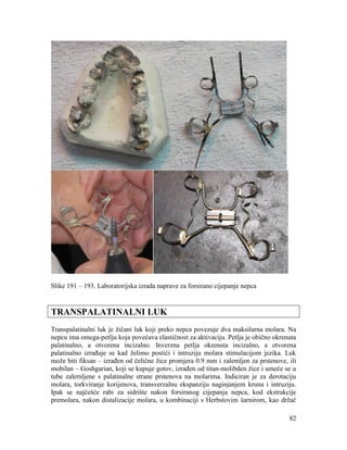 82
Slike 191 – 193. Laboratorijska izrada naprave za forsirano cijepanje nepca
TRANSPALATINALNI LUK
Transpalatinalni luk je žičani luk koji preko nepca povezuje dva maksilarna molara. Na
nepcu ima omega-petlju koja povećava elastičnost za aktivaciju. Petlja je obično okrenuta
palatinalno, a otvorena incizalno. Inverzna petlja okrenuta incizalno, a otvorena
palatinalno izrađuje se kad želimo postići i intruziju molara stimulacijom jezika. Luk
može biti fiksan – izrađen od čelične žice promjera 0.9 mm i zalemljen za prstenove, ili
mobilan – Goshgarian, koji se kupuje gotov, izrađen od titan-molibden žice i umeće se u
tube zalemljene s palatinalne strane prstenova na molarima. Indiciran je za derotaciju
molara, torkviranje korijenova, transverzalnu ekspanziju naginjanjem kruna i intruziju.
Ipak se najčešće rabi za sidrište nakon forsiranog cijepanja nepca, kod ekstrakcije
premolara, nakon distalizacije molara, u kombinaciji s Herbstovim šarnirom, kao držač
 