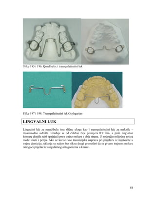 84
Slike 195 i 196. Quad helix i transpalatinalni luk
Slike 197 i 198. Transpalatinalni luk Goshgarian
LINGVALNI LUK
Lingvalni luk za mandibulu ima sličnu ulogu kao i transpalatinalni luk za maksilu –
maksimalno sidrište. Izrađuje se od čelične žice promjera 0.9 mm, a prati lingvalne
konture donjih zubi spajajući prve trajne molare s obje strane. U području mliječne petice
može imati i petlju. Ako se koristi kao tranzicijska naprava pri prijelazu iz mješovite u
trajnu denticiju, uklanja se nakon što niknu drugi premolari da se prvom trajnom molaru
omogući prijelaz iz singularnog antagonizma u klasu I.
 