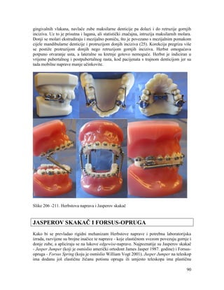 90
gingivalnih vlakana, navlače zube maksilarne denticije pa dolazi i do retruzije gornjih
inciziva. Uz to je prisutna i lagana, ali statistički značajna, intruzija maksilarnih molara.
Donji se molari ekstrudiraju i mezijalno pomiču, što je povezano s mezijalnim pomakom
cijele mandibularne denticije i protruzijom donjih inciziva (25). Korekcija pregriza više
se postiže protruzijom donjih nego retruzijom gornjih inciziva. Herbst omogućava
potpuno otvaranje usta, a lateralne su kretnje gotovo nemoguće. Herbst je indiciran u
vrijeme pubertalnog i postpubertalnog rasta, kod pacijenata s trajnom denticijom jer su
tada mobilne naprave manje učinkovite.
Slike 206 -211. Herbstova naprava i Jasperov skakač
JASPEROV SKAKAČ I FORSUS-OPRUGA
Kako bi se prevladao rigidni mehanizam Herbstove naprave i potrebna laboratorijska
izrada, razvijene su brojne inačice te naprave - koje elastičnom svezom povezuju gornje i
donje zube, a apliciraju se na lukove edgewise-naprave. Najpoznatije su Jasperov skakač
- Jasper Jumper (koji je osmislio američki ortodont James Jasper 1987. godine) i Forsus-
opruga - Forsus Spring (koju je osmislio William Vogt 2001). Jusper Jumper na teleskop
ima dodanu još elastičnu žičanu potisnu oprugu ili umjesto teleskopa ima plastičnu
 