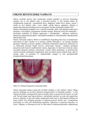 93
FIKSNE RETENCIJSKE NAPRAVE
Nakon završetka aktivne faze ortodontske terapije potrebno je provesti retencijsku
terapiju, čiji je cilj zadržati zube u pravilnoj poziciji. U tom periodu dolazi do
reorganizacije gingivnih i parodontnih tkiva, adaptacije mekih tkiva obraza, usnica i
jezika na novi položaj zuba i nove oblike zubnih lukova, adaptacije okluzije te
sprečavanja utjecaja preostalog rasta na postignuti rezultat ortodontske terapije (38).
Dužina retencijskog razdoblja ovisi o prirodi anomalije, dobi, individualnoj reaktivnosti
pacijenta, vrsti terapije i postignutom rezultatu terapije. Retencija može biti mehanička –
provedena mobilnim ili fiksnim napravama i nemehanička - uključuje selektivno
ubrušavnje aproksimalnih ploha i okluzijskih kontakata te cirkumferentnu suprakrestalnu
fiberotomiju (39).
Fiksne retencijske naprave obično su modifikacije lingvalnog luka koji se kompozitom
pričvršćuje za zube. Ugodne su za nošenje, estetski prihvatljive i ne iziskuju suradnju
pacijenta. Najčešće se koriste zajedno s mobilnim retencijskim napravama. Indicirane su
za održavanje položaja donjih inciziva, sprečavanje rotacije i mogućih promjena
prouzrokovanih kasnim madibularnim rastom, dugotrajnu ili doživotnu retenciju nakon
zatvaranje diasteme mediane, rastresitosti u fronti, nakon ekstrakcija, za poravnavanje
izrazito rotiranih, palatinalno impaktiranih zubi, kao držač mjesta između dvaju zuba za
nicanje zuba, za protetsku ili implantološku terapiju te kod parodontološki
kompromitiranih pacijenata.
Slika 214. Žičano-kompozitni retencijski splint
Fiksne retencijske naprave mogu biti tvornički izrađene, u više veličina i tipova. Mogu
pasivno prilijegati uz površine sjekutića omogućavajući im fiziološke pomake - u tom
slučaju učvršćuju se kompozitom samo za krajnje zube, no mogu biti učvršćene i za svaki
zub. Na sebi mogu imati baznu pločicu s retencijskim utorima, za svaki zub, poput baze
bravice. Najčešće se pak rabi žičano–kompozitni splint koji se individualno oblikuje od
kruće čelične žice okruglog promjera ili upletene pasivne čelične žice i kompozitom
pričvršćuje za svaki zub interkaninog segmenta. Uglavnom se postavlja lingvalno, no
može i labijano, za fiksiranje dva do tri zuba nakon izvlačenja palatinalno impaktiranog
 